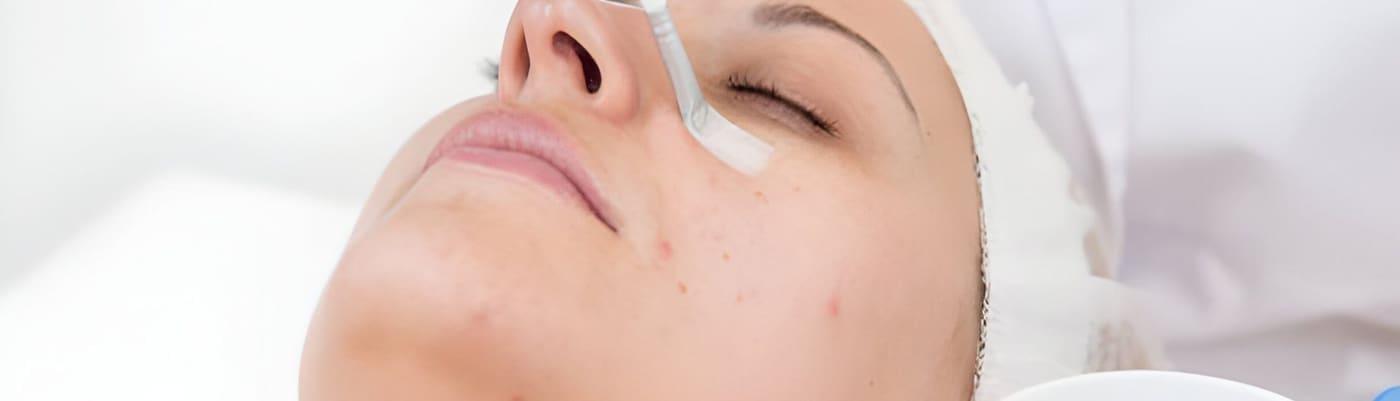 A chemical peel solution painted onto the cheek with precision